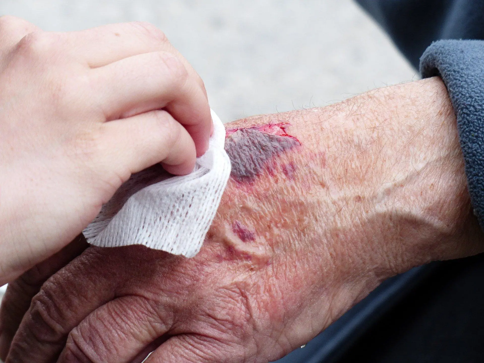 Wound Care After Sutures | Learn the Secrets of Wound Care
