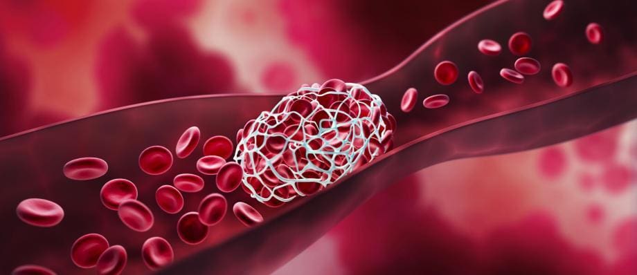 أسباب تجلط الدم وأعراضه وطرق العلاج